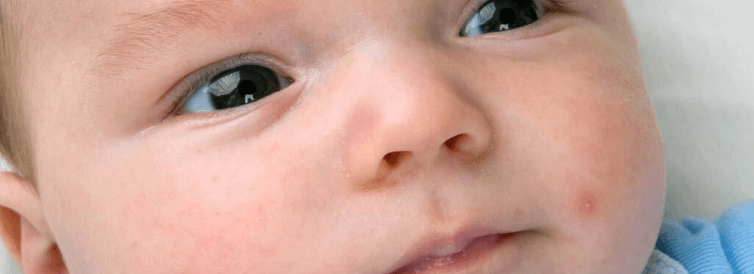 Granitos del bebé: ¿a qué se deben?